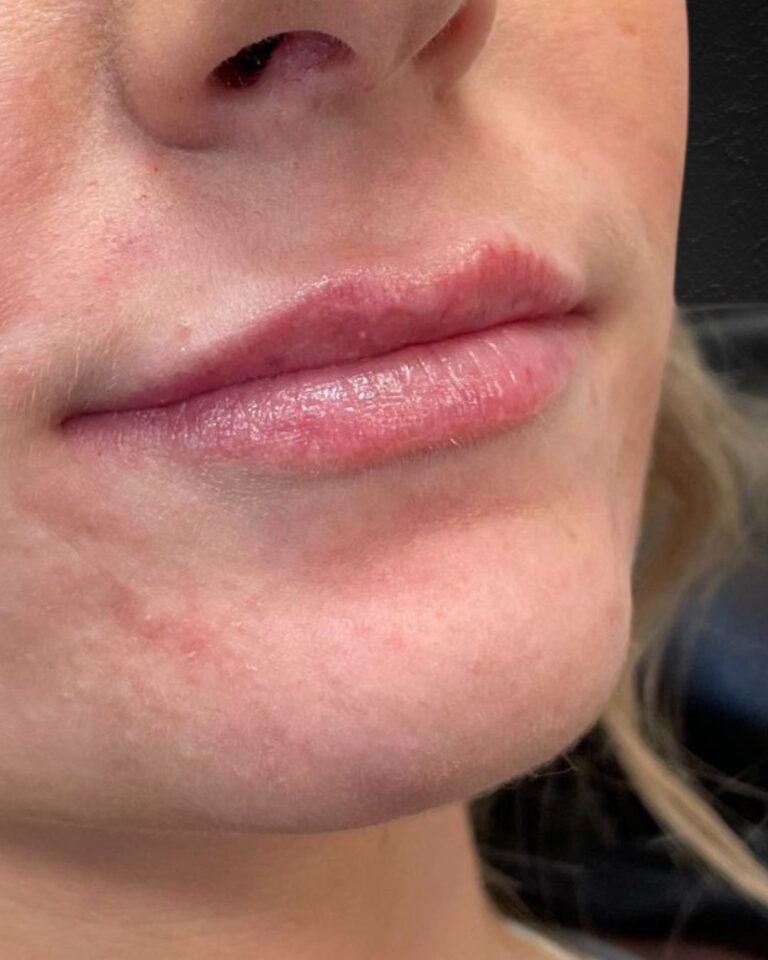 After Image: Lip Filler - right-front-oblique