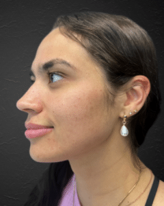 After Image: EMatrix + Chemical Peels + Skincare