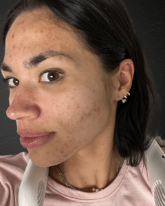 Before Image: EMatrix + Chemical Peels + Skincare