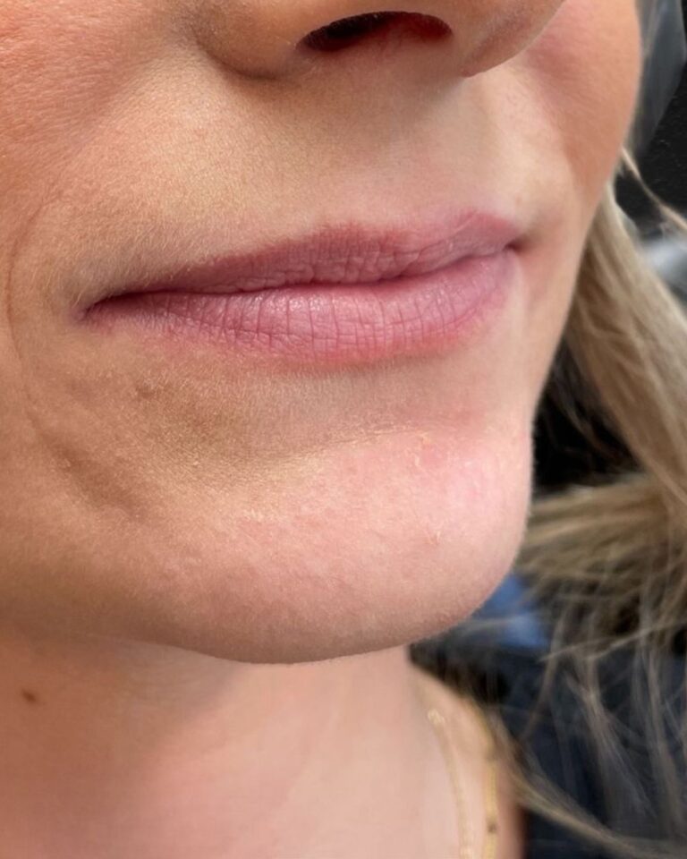 Before Image: Lip Filler - right-front-oblique