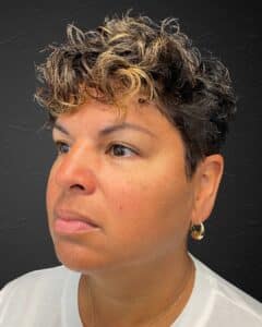 Before Image: Sculpt & Restore with Juvederm Filler