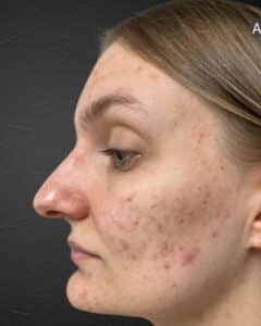 Before Image: Acne Healing Process