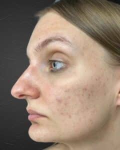 After Image: Acne Healing Process
