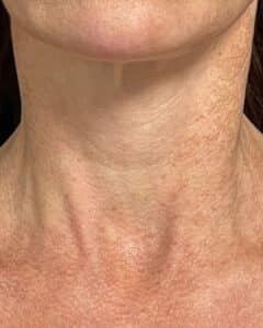 Before Image: Skinvive Skin Booster