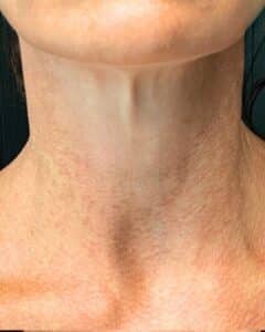 After Image: Skinvive Skin Booster