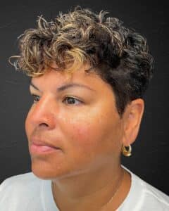 After Image: Sculpt & Restore with Juvederm Filler