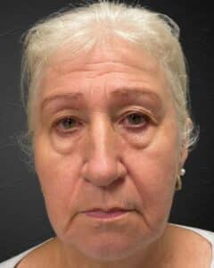 Before Image: Sculpt & Restore with Juvederm Filler