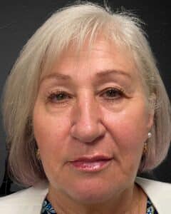 After Image: Sculpt & Restore with Juvederm Filler