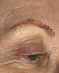 Before Image: Eyebrow Tattoo Removal