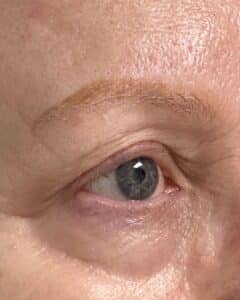 After Image: Eyebrow Tattoo Removal