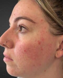 Before Image: Chemical Peel + BroadBand Light