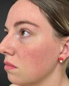 After Image: Chemical Peel + BroadBand Light