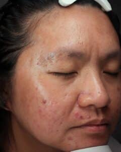 Before Image: Medical Grade Skincare, EMatrix, and HydraFacial