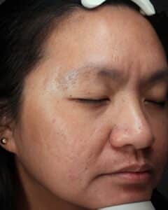 After Image: Medical Grade Skincare, EMatrix, and HydraFacial